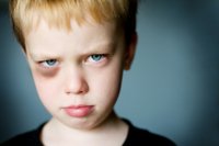 child with black eye